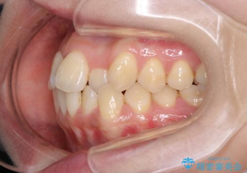 【ワイヤー矯正】前歯のがたつきを短期間で治したいの治療前