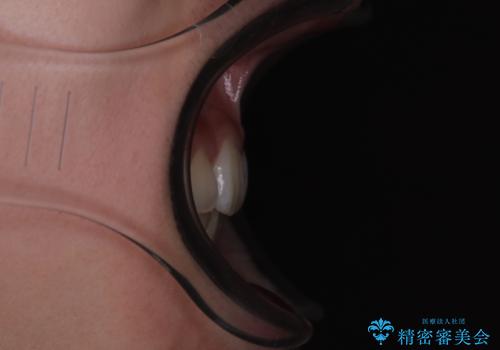 飛び出した上顎前歯 ワイヤー装置にて抜歯矯正治療の治療後