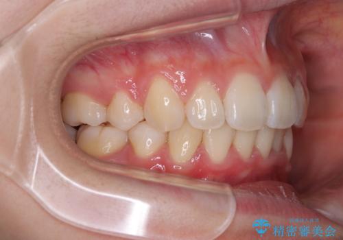 飛び出した上顎前歯 ワイヤー装置にて抜歯矯正治療の治療後