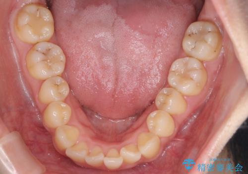 【ワイヤー矯正】前歯のがたつきを短期間で治したいの治療前