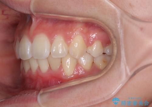 飛び出した上顎前歯 ワイヤー装置にて抜歯矯正治療の治療後