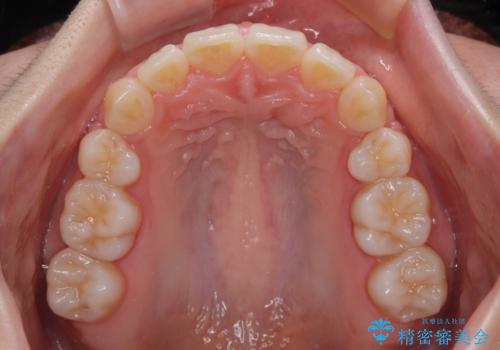 飛び出した上顎前歯 ワイヤー装置にて抜歯矯正治療の治療後