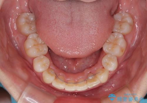 飛び出した上顎前歯 ワイヤー装置にて抜歯矯正治療の治療後