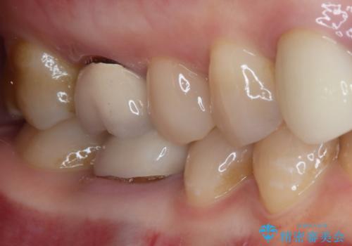 1DAYインプラント 破折して痛みの強い歯 抜歯即時埋入で抜歯した日に仮歯を装着の治療前