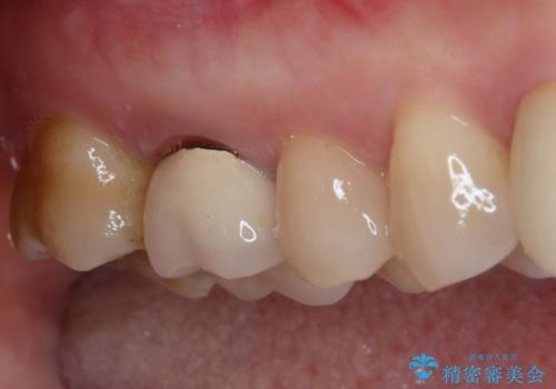 1DAYインプラント 破折して痛みの強い歯 抜歯即時埋入で抜歯した日に仮歯を装着の治療前