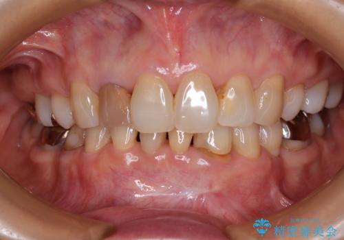 奥歯の目立つ銀歯をセラミックに オールセラミッククラウン治療の治療前