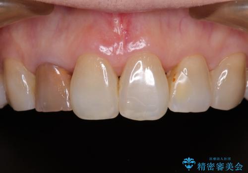 奥歯の目立つ銀歯をセラミックに オールセラミッククラウン治療の治療前