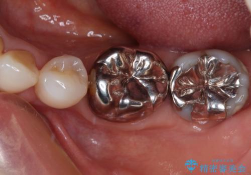 奥歯の目立つ銀歯をセラミックに オールセラミッククラウン治療の治療前