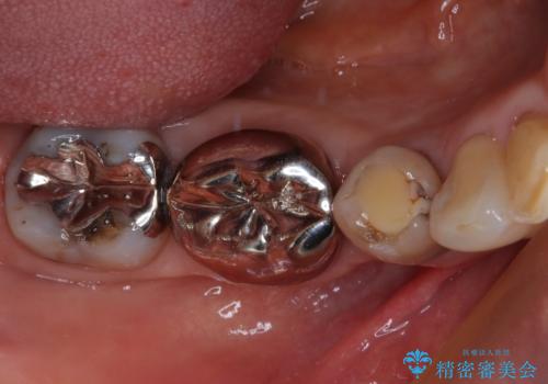 奥歯の目立つ銀歯をセラミックに オールセラミッククラウン治療の治療前