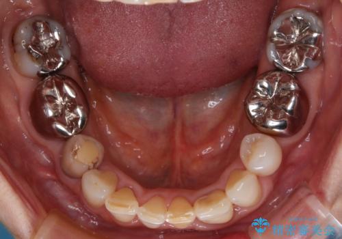 奥歯の目立つ銀歯をセラミックに　オールセラミッククラウン治療の症例 治療前