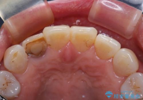 奥歯の目立つ銀歯をセラミックに オールセラミッククラウン治療の治療前