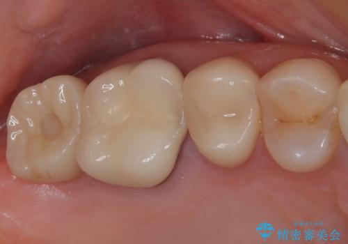 1DAYインプラント 破折して痛みの強い歯 抜歯即時埋入で抜歯した日に仮歯を装着の症例 治療後