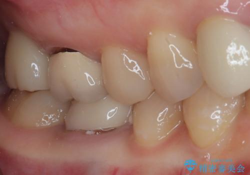 1DAYインプラント 破折して痛みの強い歯 抜歯即時埋入で抜歯した日に仮歯を装着の治療後