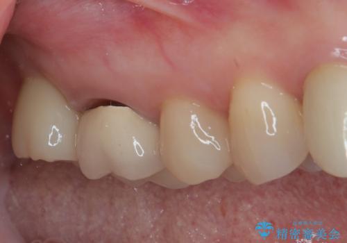 1DAYインプラント 破折して痛みの強い歯 抜歯即時埋入で抜歯した日に仮歯を装着の治療後