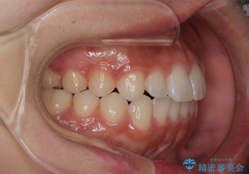 【インビザライン】がたつきをマウスピースできれいにしたいの治療後
