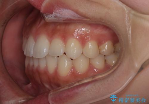 【インビザライン】がたつきをマウスピースできれいにしたいの治療後