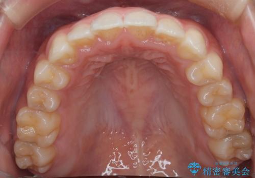 【インビザライン】がたつきをマウスピースできれいにしたいの治療後