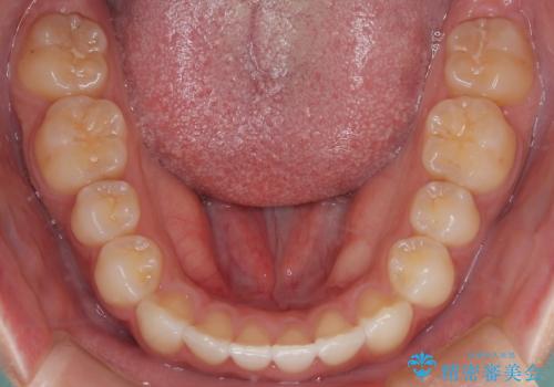 【インビザライン】がたつきをマウスピースできれいにしたいの治療後