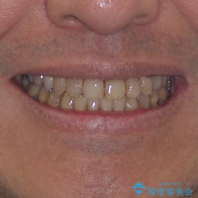 今からでも綺麗な歯並びを手に入れたい 40代男性のワイヤー矯正の治療後(顔貌)