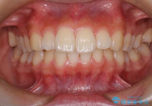 裏側矯正で口元をすっきりとした印象へ!の症例 治療前