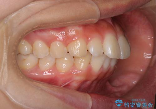 裏側矯正で口元をすっきりとした印象へ!の治療前