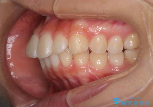 裏側矯正で口元をすっきりとした印象へ!の治療前