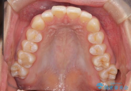 裏側矯正で口元をすっきりとした印象へ!の治療前