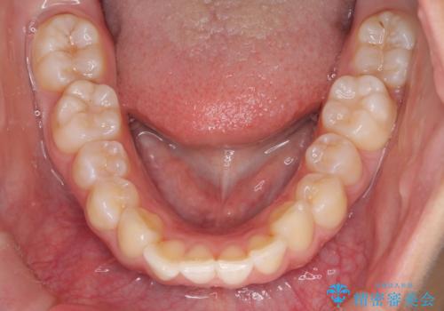 裏側矯正で口元をすっきりとした印象へ!の治療前