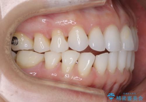 【非抜歯】マウスピースでオープンバイトを治すの治療中