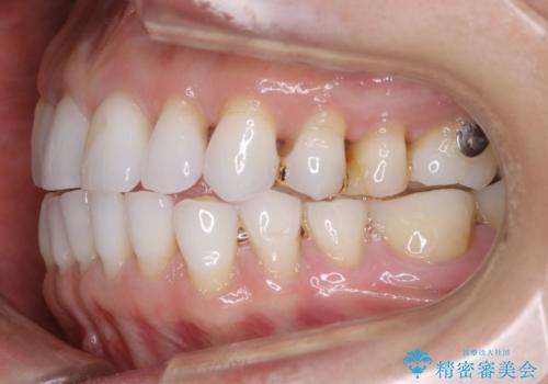 【非抜歯】マウスピースでオープンバイトを治すの治療中