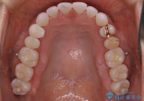 【非抜歯】マウスピースでオープンバイトを治すの治療中