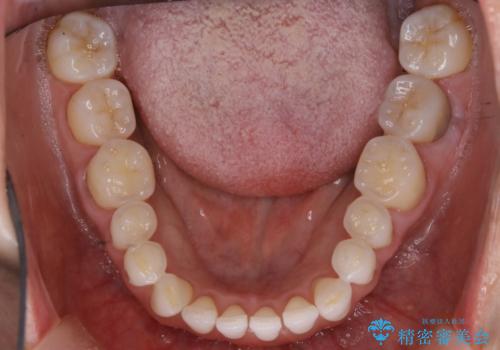 【非抜歯】マウスピースでオープンバイトを治すの治療中