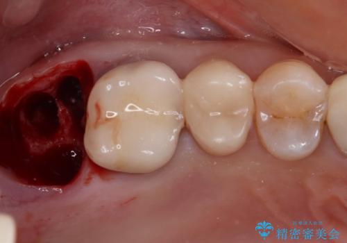 1DAYインプラント 破折して痛みの強い歯 抜歯即時埋入で抜歯した日に仮歯を装着の治療後