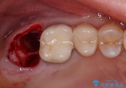1DAYインプラント　破折して痛みの強い歯　抜歯即時埋入で抜歯した日に仮歯を装着の治療前