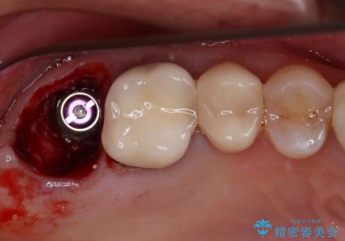 1DAYインプラント 破折して痛みの強い歯 抜歯即時埋入で抜歯した日に仮歯を装着
