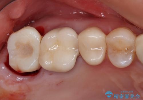 1DAYインプラント 破折して痛みの強い歯 抜歯即時埋入で抜歯した日に仮歯を装着の治療後