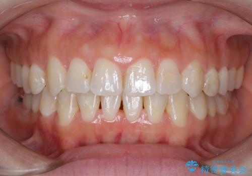 オープンバイト、噛んだ時に前歯が閉じない(開咬)をインビザラインでの治療後