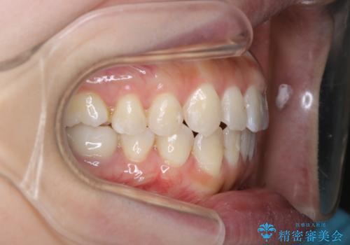 オープンバイト、噛んだ時に前歯が閉じない(開咬)をインビザラインでの治療後