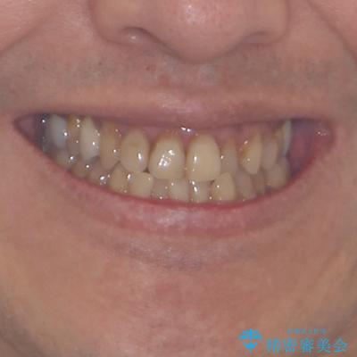 今からでも綺麗な歯並びを手に入れたい 40代男性のワイヤー矯正の治療前(顔貌)