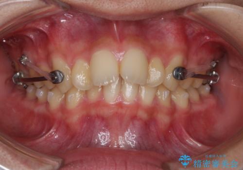 非抜歯で劇的に出っ歯を改善!インビザラインとカリエールの組み合わせ治療の治療中