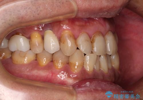 今からでも綺麗な歯並びを手に入れたい 40代男性のワイヤー矯正の治療前