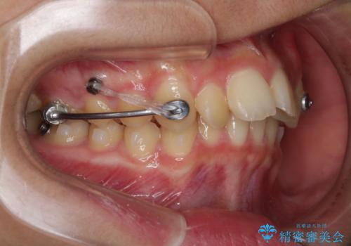 非抜歯で劇的に出っ歯を改善!インビザラインとカリエールの組み合わせ治療の治療中