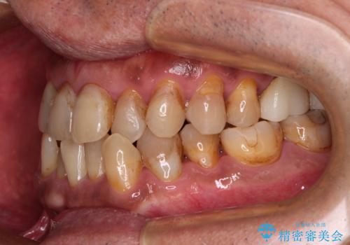 今からでも綺麗な歯並びを手に入れたい 40代男性のワイヤー矯正の治療前