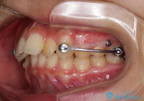 非抜歯で劇的に出っ歯を改善!インビザラインとカリエールの組み合わせ治療の治療中