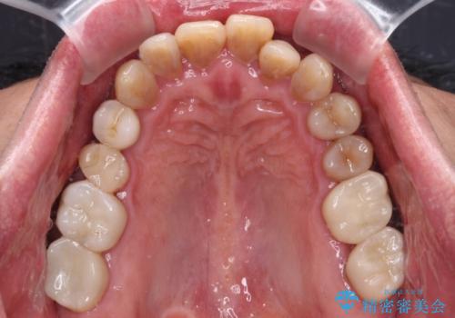 今からでも綺麗な歯並びを手に入れたい 40代男性のワイヤー矯正の治療前