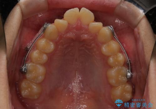 非抜歯で劇的に出っ歯を改善!インビザラインとカリエールの組み合わせ治療の治療中