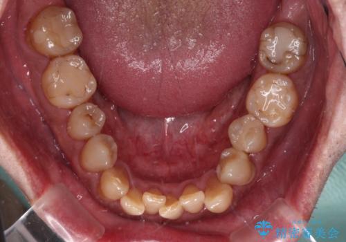 今からでも綺麗な歯並びを手に入れたい 40代男性のワイヤー矯正の治療前