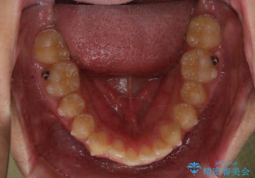 非抜歯で劇的に出っ歯を改善!インビザラインとカリエールの組み合わせ治療の治療中