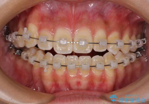 八重歯とオープンバイト　急速拡大装置を用いた矯正治療の治療中