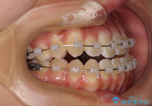 八重歯とオープンバイト 急速拡大装置を用いた矯正治療の治療中